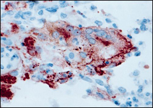 Lung of pilot whale. Positive intracytoplasmic and intranuclear immunoperoxidase staining of morbilliviral antigen in syncytial cell (center) and bronchiolar epithelium (lower left). Avidin-biotin-peroxidase with Harris' hematoxylin counterstain. Original magnification 594x.