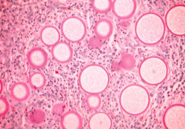 Histology of rhinosporidiosis. A formaldehyde-fixed section of human nasal polyp was stained with Periodic acid-Schiff (PAS) and visualized by bright-field microscopy at 400X magnification. The thick walls of immature R. seeberi trophocytes stain with PAS (pink), and the spherical organisms are surrounded by inflammatory cells.