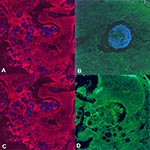 Thumbnail of An oligonucleotide probe complementary to a unique region of the Rhinosporidium seeberi 18S rRNA sequence localizes to visible organisms in human nasal tissue by using fluorescence in situ hybridization. Confocal micrographs at 200X magnification. The Cy-5-labeled Rhinosporidium probe (blue) hybridizes to spherical R. seeberi trophocytes (A) and a sporangium with endospores (B). A control probe consisting of the complement of the Rhinosporidium probe labeled with Cy-5 does not hybri