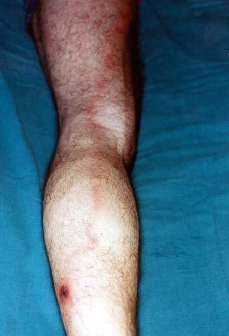 Lymphangitis expanding from the inoculation eschar on the left leg to an enlarged, painful lymph node on the left groin of a patient with Rickettsia mongolotimonae infection.