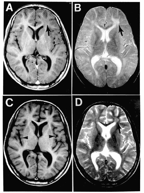 MRI scans of the brain at the time of presentation in the neurology clinic (A and B) and 3 months later (C and D). Panels A and C are T1-weighted images; B and D are T2-weighted images. The initial MRI scan (A and B) reveals a focal abnormality in the subcortical white matter of the left frontal lobe, consisting of a hypointense signal on the T1-weighted image (arrow in A) and a hyperintense signal on the T2-weighted image (arrow in B). In the followup scan, the focal abnormality in the left fro
