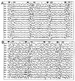 Thumbnail of Electroencephalogram (EEG) at the time of presentation in the neurology clinic (A) and 3 months later (B). The initial EEG (A) reveals periodic bursts of high-amplitude, slow-wave complexes. (Onset of the complexes is indicated by solid arrows; offset, by open arrows.) The background rhythm is normal, except for bifrontal slowing. This "burst-suppression" pattern is highly characteristic of subacute sclerosing panencephalitis (4). EEG 3 months later, when the patient's clinical stat