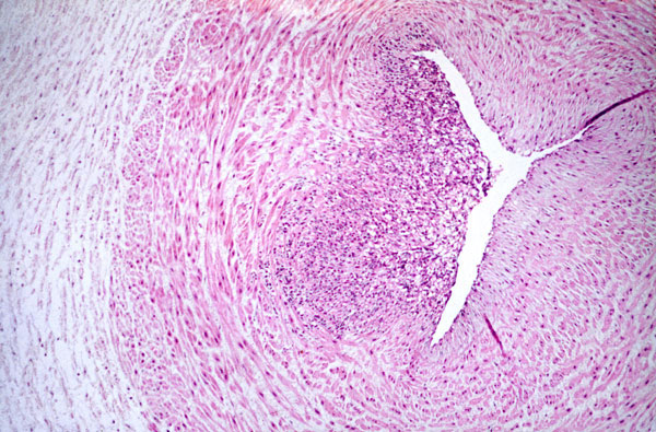 Umbilical artery, showing marked inflammation in the intima of the vessels.