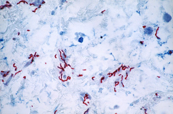 Immunohistochemistry for Treponema pallidum in an area with few inflammatory infiltrates and multiple spirochetes.