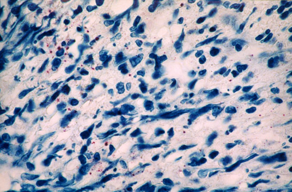 Immunohistochemistry for Treponema pallidum in an area with marked inflammatory infiltrate with granular staining; no intact spirochetes are noted.