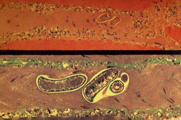 Sections of a muscle biopsy specimen from a patient infected with Trichinella pseudospiralis on day 32 after infection. The identified larva is nonencapsulated. Inflammatory cells are noted in the interstitium. Upper panel: hematoxylin and eosin stain at 50X magnification. Bottom panel: Masson trichrome stain at 100X magnification.