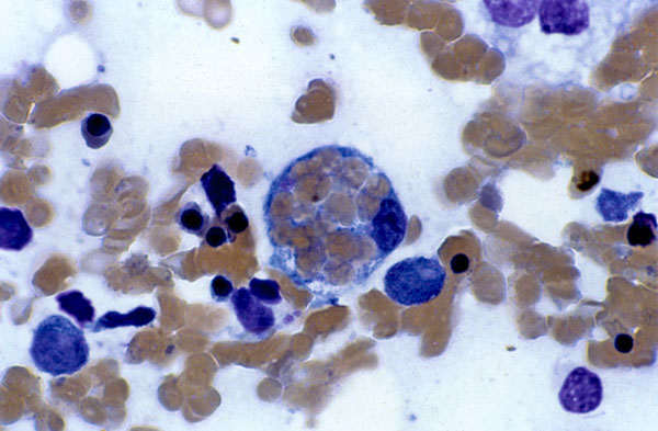 Hemophagocytosis in the bone marrow of an 18-year-old woman with Epstein-Barr virus (EBV)-associated hemophagocytic lymphohistiocytosis. The patient visited her physician in September 1997 with pharyngitis and an elevated heterophile agglutinin titer. She was diagnosed with infectious mononucleosis, and her symptoms resolved in 2 weeks. Approximately 2 months later, she had persistent, spiking fevers and became jaundiced; her immunoglobulin (Ig) M to EBV capsid antigen was positive; and EBV caps