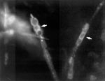 Thumbnail of Coccidioides immitis hyphae dislodged from the tip of the ventriculo-peritoneal catheter tip, fixed in formalin and stained with Calcofluor. Stained barrel-shaped arthroconidia (arrows) are seen, along with empty cells (x400). The upper left image shows a section from the tip of the shunt tubing stained with SYTOX Green nucleic acid stain and examined by scanning confocal microscopy with argon-ion laser light source. This specific staining for nucleic acids clearly shows the presence of a biofilm and some 4- to 6-μm cells. The upper right image shows an unstained, transmitted light microscopic image of the same area of the edge of the tubing. The bottom right image shows a recombined image with the nucleic acid stain colocalized with the transmitted light image. The recombined image shows that a substantial (~30 μm) biofilm composed of 4- to 6-μm cells has colonized the “scalloped” surface of this tubing. (x630 total magnification mosaic)