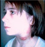 Thumbnail of Girl with ulcerating lymphadenitis colli due to tularemia, Kosovo, April 2000.