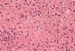 Thumbnail of Photomicrograph of a section of the cerebral cortex from horse with Eastern equine encephalomyelitis virus infection. Note the dense neutrophilic response, vascular damage, and fibrin thrombi. Hematoxylin and eosine stain.
