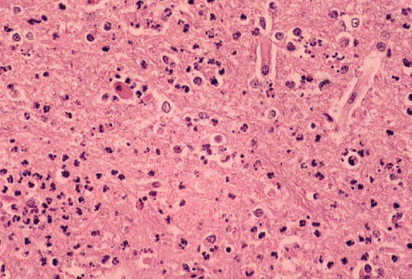 Photomicrograph of a section of the cerebral cortex from horse with Eastern equine encephalomyelitis virus infection. Note the dense neutrophilic response, vascular damage, and fibrin thrombi. Hematoxylin and eosine stain.