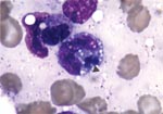 Thumbnail of Bone marrow examination (Wright's stain x1000). Intraleukocytic morulae of Ehrlichia can be seen (arrow) within monocytoid cells.