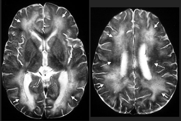 Biopsy-proven Baylisascaris procyonis encephalitis in a 13-month-old boy. Axial T2-weighted magnetic resonance images obtained 12 days after symptom onset show abnormal high signal throughout most of the central white matter (arrows) compared with the dark signal expected at this age (broken arrows).