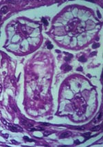 Thumbnail of Cross-section of Baylisascaris procyonis larva in tissue section of brain, demonstrating characteristic diagnostic features including prominent lateral alae and excretory columns.