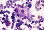 Thumbnail of Bone marrow aspirate showing phagocytosis of neutrophil, nucleated erythrocyte, and platelets by benign histiocytes (Wright stain, x400).