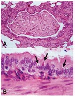 Thumbnail of Lung lesions in an African wild dog with canine distemper. Hematoxylin and eosin staining. A. Bronchiole occluded by inflammatory cells and cell debris. B. Detail of A, showing multiple eosinophilic intracytoplasmic viral inclusions (arrows) in bronchiolar epithelium.
