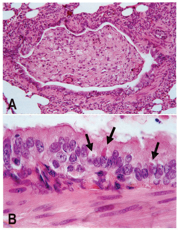 Lung lesions in an African wild dog with canine distemper. Hematoxylin and eosin staining. A. Bronchiole occluded by inflammatory cells and cell debris. B. Detail of A, showing multiple eosinophilic intracytoplasmic viral inclusions (arrows) in bronchiolar epithelium.