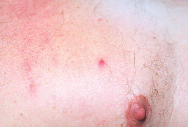 Closer view of papulovesicular lesions on patient with rickettsialpox.