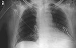 Thumbnail of Initial chest X-ray (Case 1) showing prominent superior mediastinum and possible small left pleural effusion.