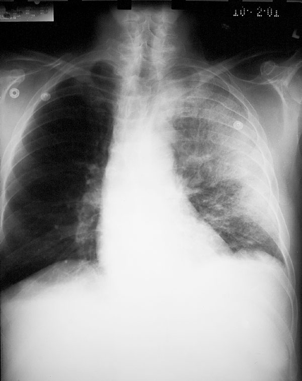 Chest X-ray (Case 2) showing diffuse consolidation consistent with pneumonia throughout the left lung. There is no evidence of mediastinal widening.