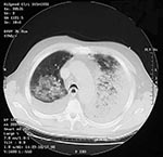 Thumbnail of Computed tomography of chest (Case 2) showing bilateral pulmonary consolidation and pleural effusions.