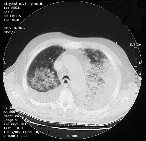 Computed tomography of chest (Case 2) showing bilateral pulmonary consolidation and pleural effusions.
