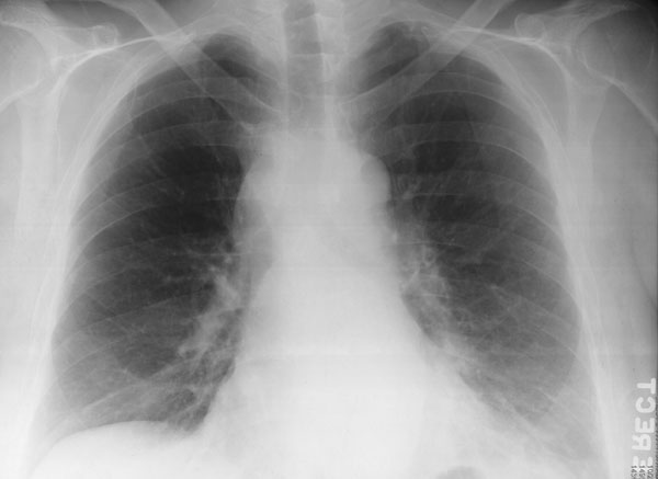 Chest X-ray (Case 7) showing mediastinal widening and a small left pleural effusion.
