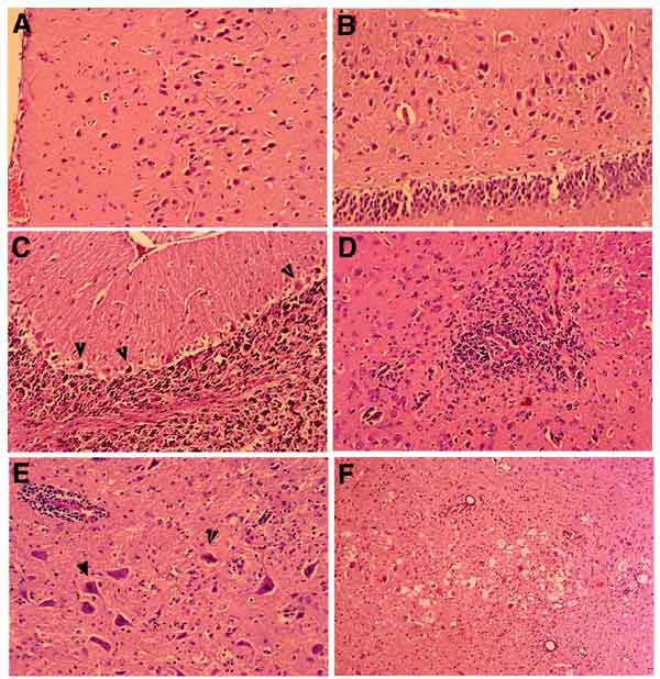 Histologic changes in brains of West Nile virus-infected hamsters. A. Cerebral cortex, with many degenerating neurons, day 6 postinfection. B. Hippocampus, showing large neurons undergoing degeneration, day 6. C. Cerebellar cortex, with frequent Purkinje call degeneration (shrunken cells, arrowheads) and loss, day 8. D. A microglial nodule near blood vessel in basal ganglia, day 9. E. Mild perivascular inflammation (upper left field), neurons with nuclear condensation (arrowhead) and cytoplasmic