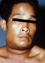 Thumbnail of A 29-year-old man, 1 day after the onset of symptoms of oropharyngeal anthrax. Marked and painful swelling of the right side of the neck was present.