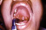 Thumbnail of A 27-year-old man, 5 days after the onset of symptoms of oropharyngeal anthrax. Edema and congestion of the right tonsil extending to the anterior and posterior pillars of fauces as well as the soft palate and uvula were present. A white patch had begun to appear at the center of the lesion.