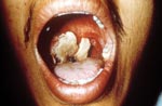 Thumbnail of The same patient as in Figure 2. This picture is 9 days after the onset of symptoms of oropharyngeal anthrax. The white patch had developed into a pseudomembrane covering the lesion.