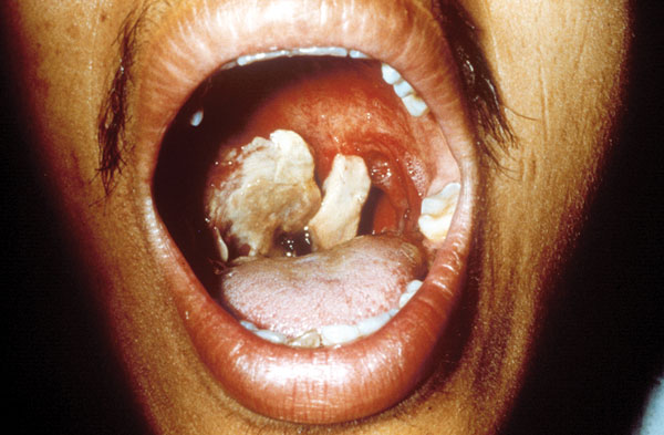 The same patient as in Figure 2. This picture is 9 days after the onset of symptoms of oropharyngeal anthrax. The white patch had developed into a pseudomembrane covering the lesion.