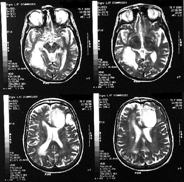 Magnetic resonance imaging (MRI) of the brain obtained after first drainage.