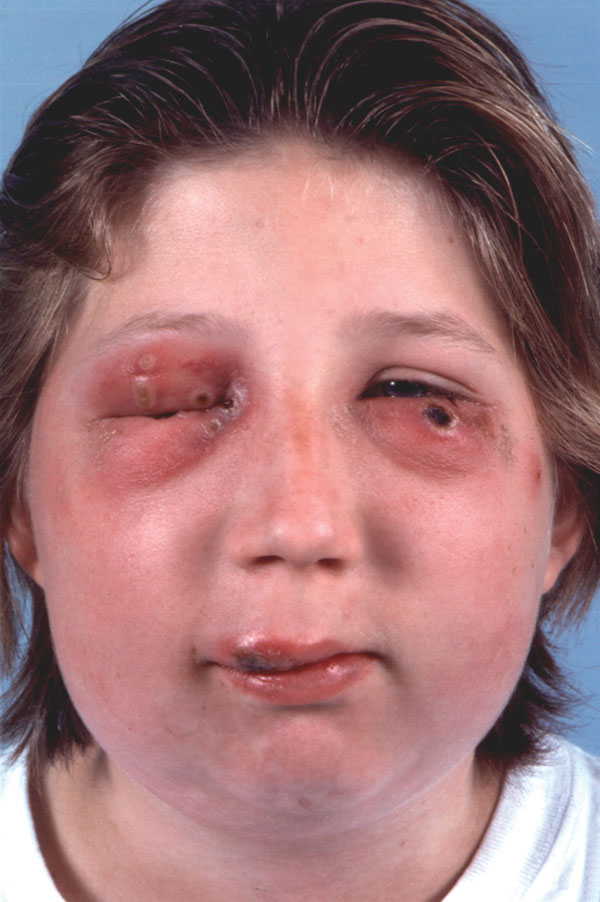 Cowpox lesions with ulcerated nodules on upper lip and left lower eyelid, several molluscum-like-lesions on the right eyelids, and oedema and erythema of the right side of the face.