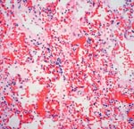 Thumbnail of Interstitial pneumonitis in the 14-month-old girl who died of human enterovirus 71 disease. Photomicrograph shows alveolar wall congestion, intra-alveolar hemorrhage, and interstitial lymphocytic infiltrate. (Hematoxylin and eosin stain, original magnification x 200).
