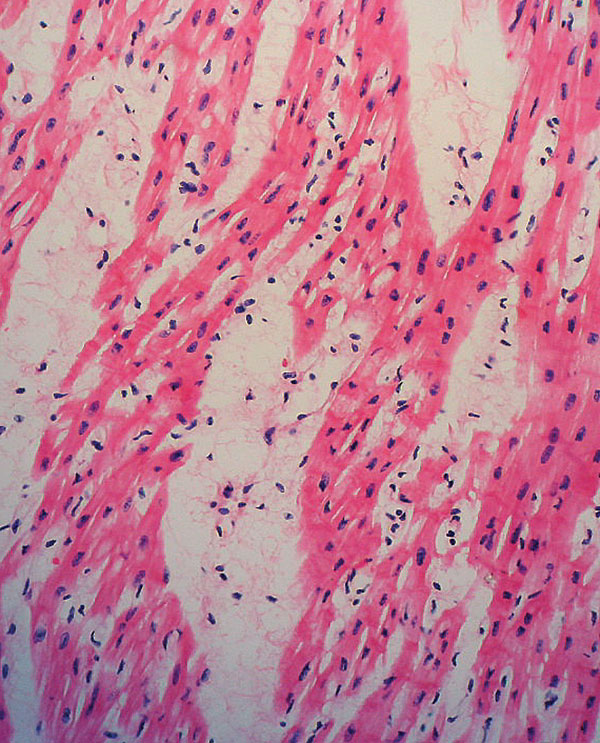 Tissue section of heart showing lymphocytic infiltrate, interstitial edema, and myocardial necrosis. (Hematoxylin and eosin stain, original magnification x200).