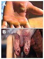 Thumbnail of Lesions from suspected Araçatuba virus on hand of dairy farm worker (milker) (A) and teats of cow (B).