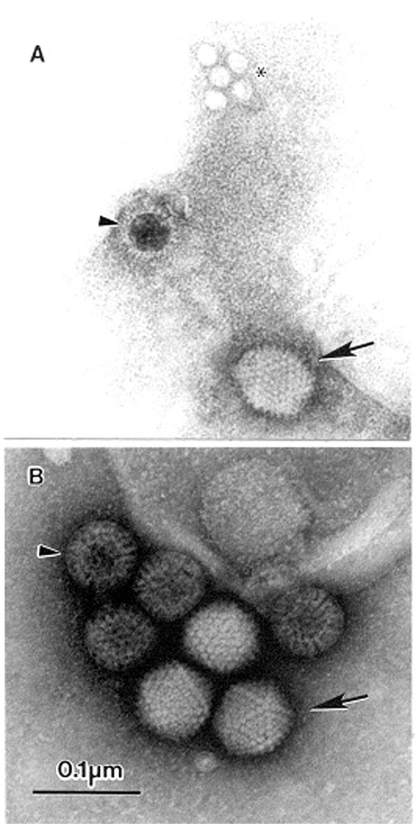 The open view of diagnostic electron microscopy. A. Multiple agents observed in a fecal sample from a pediatric patient with diarrhea. A 10% suspension was prepared in distilled water, cleared by low-speed centrifugation followed by 5 minutes at 15,000 x g in a bench top centrifuge, and centrifuged directly to the grid using an Airfuge EM-90 rotor (Beckman, Palo Alto, CA): adenovirus-(→), incomplete rotavirus-particle (&gt;), and small round featureless particles, probably adeno-associated virus