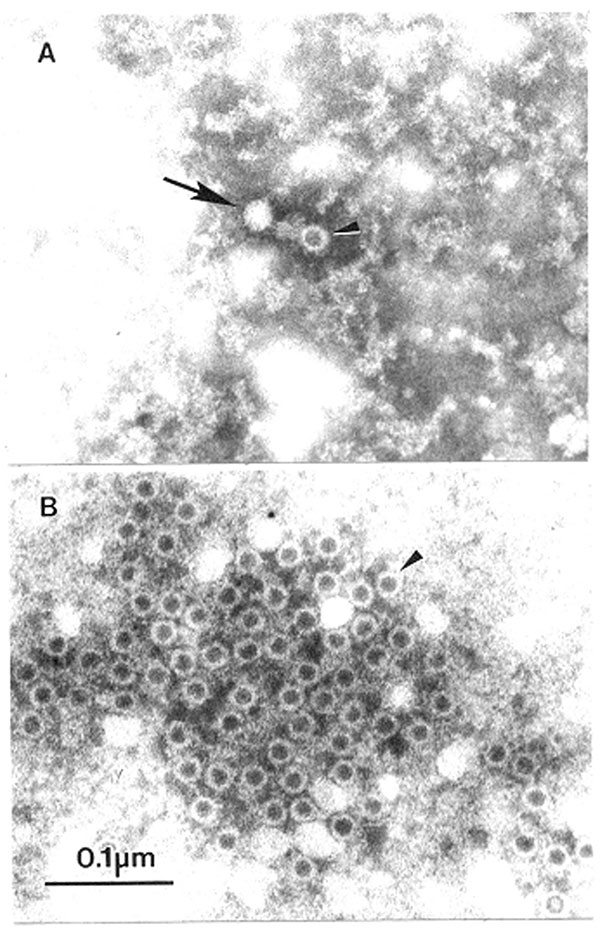 Association of human parvovirus B-19 with erythema infectiosum by immuno electron microscopic. A. Airfuge EM-90 rotor (Beckman, Palo Alto, CA) preparation of human serum prospectively collected at time of contact with case of erythema infectiosum. Erythema infectiosum-like rash developed 1 week after collection of serum. B. Immuno electron microscopic preparation of the serum in panel A. The serum was mixed with matched convalescent-phase serum (final dilution convalescent-phase serum 1:100), in