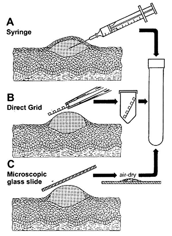 Three methods for efficient collection of vesicular and blister fluids for diagnostic electron microscopic. A. The contents of a vesicle are collected into the barrel of a needle. B. After the blister is opened, a coated electron microscopic grid is touched to the fluid and air-dried (direct electron microscopic). C. A glass microscope slide is touched directly to an unroofed lesion and a smear prepared. Samples are then placed in rigid containers for transport to the electron microscopic labora