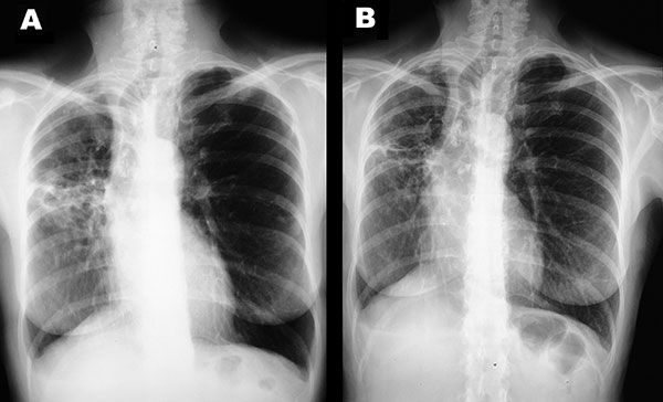 Chest x-ray showing nodular lesions and lung cavitation before (A) and after (B) treatment.