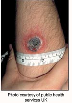 Thumbnail of Suspected cutaneous anthrax lesion from a patient in the United Kingdom. Photos like this, transmitted by e-mail, enabled clinical experts to review images of suspected cases worldwide and provide rapid assistance.