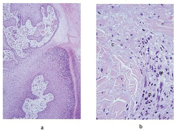 a, hematoxylin and eosin stain of the pseudoepitheliomatous hyperplasia of the epidermis in a lesion specimen showing definitive Buruli ulcer disease in the ulcerative stage (original magnification 100x). b, hematoxylin and eosin stain of the necrotic collagen (c) accompanied by mild inflammatory infiltrate in the dermis of a definitive Buruli ulcer disease lesion in the ulcerative stage (original magnification 400x). n, neutrophis; m, mononuclear cells.