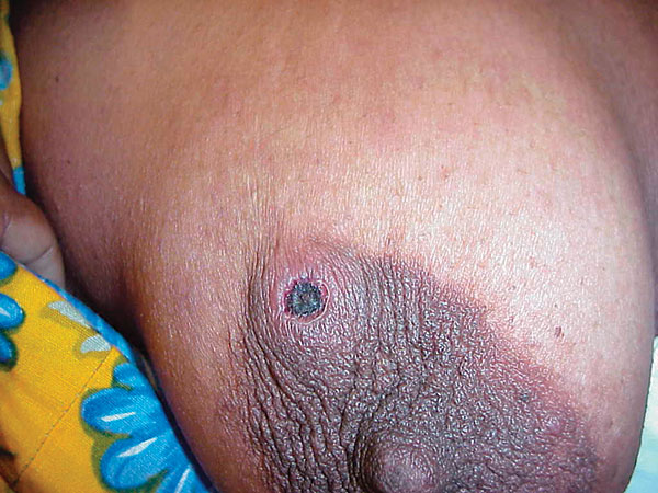 Eschar on the breast of a patient with scrub typhus during an outbreak on Darnley Island, Torres Strait.