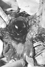 Thumbnail of Extensive edema and hemorrhage involving the cecum in a patient with intestinal anthrax.