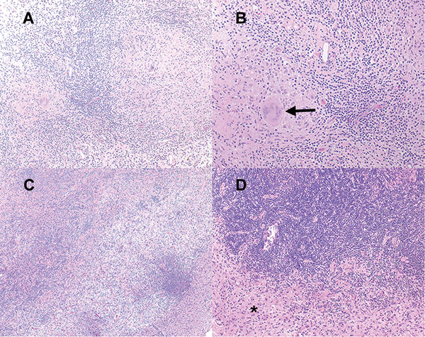 Hematoxylin and eosin–stained sections from patient 1 (panels A, B) and patient 2 (panels C, D). Note the predominantly lymphohistocytic infiltrate forming large granulomas (A, original magnification 100x); well-formed giant cells (B, arrow, original magnification 200x); lymphohistiocytic infiltrates distorting brain parenchyma and forming vague granulomas (C, original magnification 40x); and the dense astrogliosis at the interface between granulomatous inflammation and surrounding brain parench