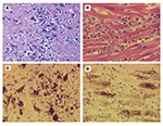 Thumbnail of Encephalitis and myocarditis in two West Nile virus–infected canids. A, histopathology of the cerebrum of the wolf. Focus of lymphocyte infiltration and necrosis with mild gliosis; arrow indicates necrotic neuron. Hematoxylin-eosin staining. B, histopathology of the heart of the dog. Focus of leukocytic infiltration, mostly lymphocytes, and myocardial cell degeneration and necrosis. Hematoxylin-eosin staining. C, West Nile virus immunohistochemistry of the cerebrum of the wolf. Inte