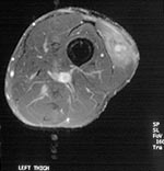 Thumbnail of Magnetic resonance image of thigh with Gnathostoma larva (case 4).