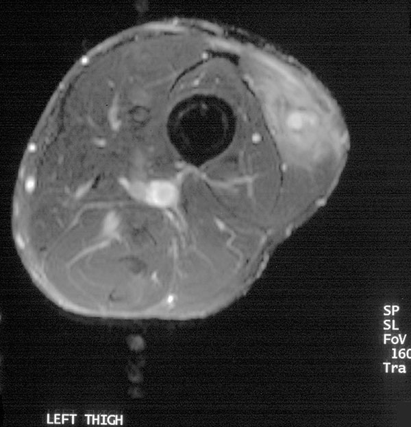 Magnetic resonance image of thigh with Gnathostoma larva (case 4).