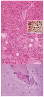 Thumbnail of Lesions in the mona monkey (hematoxylin and eosin stain): A) liver: portal triads with neutrophilic infiltration (x10); A1, presence of bacterial emboli inside the vein (arrow) (x40). B) acute pneumonia: edema, congestion, and leukocyte cells exudation in the pulmonary alveoli (x10). C) encephalitis: congestion and marginalized neutrophils in nervous vessels (x10).